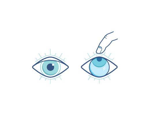 ilustrace prvního kroku vyjmutí čočky ACUVUE®: vlevo oko, vpravo oko s pohledem upřeným nahoru, ke kterému se blíží prst, aby stáhnul dolní víčko / ilustrace prvního kroku vyjmutí čočky ACUVUE®: vlevo oko, vpravo oko s pohledem upřeným nahoru, ke kterému 