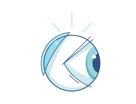 ilustrace kontaktní čočky umístěné za okem
