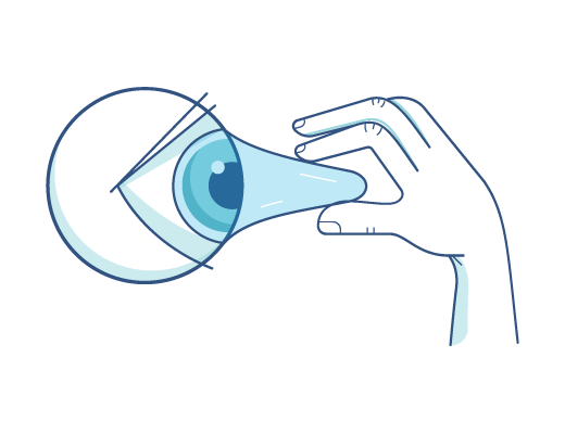 ilustrace ruky snažící se vyndat kontaktní čočku ACUVUE®, která se přilepila na oko