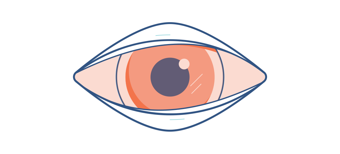 ilustrace zarudlého oka