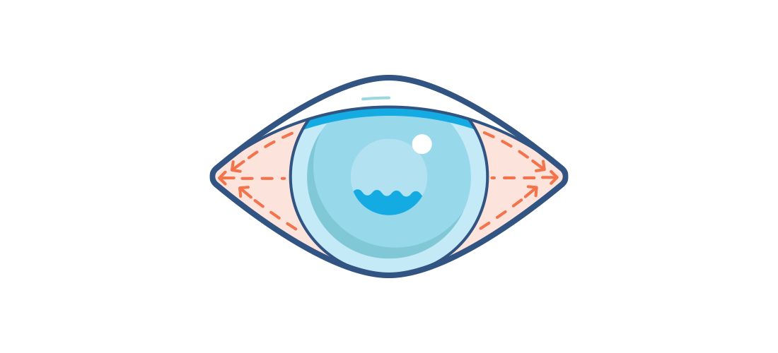 ilustrace zarudlého oční bělma