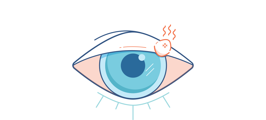 ilustrace ječného zrna na očním víčku, které způsobilo zarudnutí oka / ilustrace ječného zrna na očním víčku